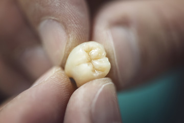 Dental Prosthesis. Artificial tooth being done by a dental prosthesis specialist.