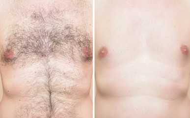 Chest of a man before and after trimming chest hair 