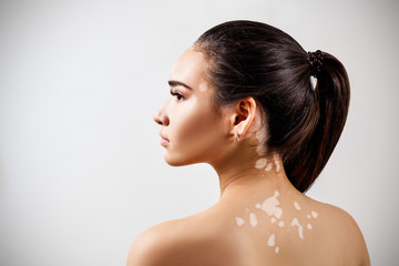 Portrait of beautiful woman with vitiligo.