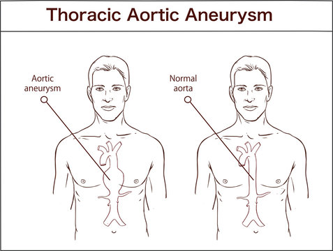 Vector Illustration Of A Abdominal Aortic Aneurysm