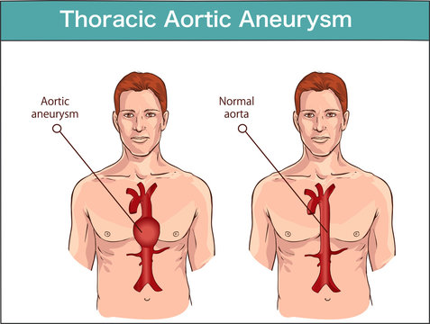 Vector Illustration Of A Abdominal Aortic Aneurysm