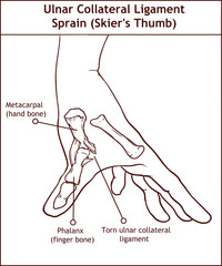 ULNAR COLLATERAL LIGAMENT SPRAIN