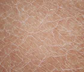 texture close - up human skin with dermatological problems of dryness and cracking