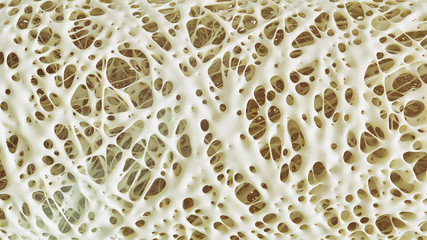Osteoporosis advanced -high details - Stage 4 - 3d rendering