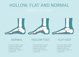 Foot deformation types,  medical desease infographic. Hollow, flat and normal foot