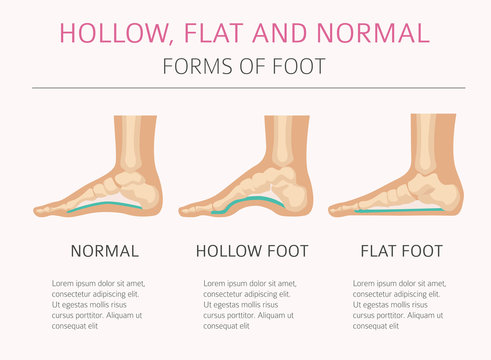 Foot deformation types,  medical desease infographic. Hollow, flat and normal foot