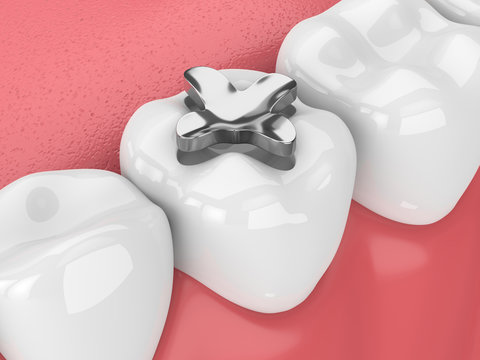 3d render of teeth with dental amalgam inlay filling