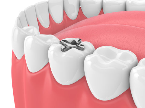 3d render of teeth with dental inlay amalgam filling