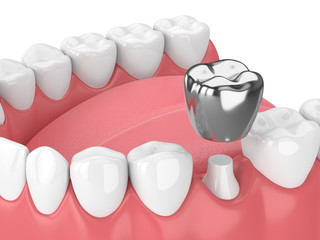 3d render of teeth with dental crown amalgam filling