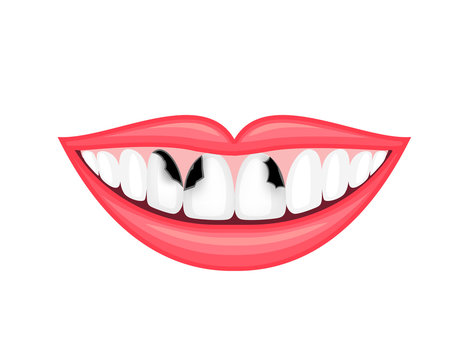 Tooth decay, unhealthy teeth. Human mouth, dental care concept. Illustration isolated on white background.