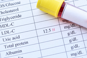 Blood sample with abnormal high uric acid test result