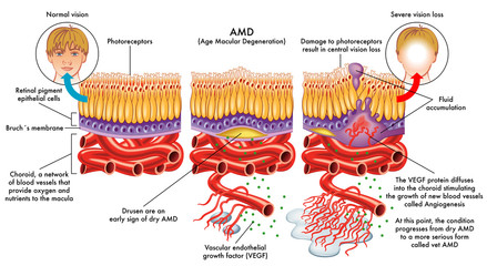 medical vector illustration of symptoms of AMD (age macular degeneration)