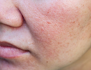 Close-up of acne on the skin, Acne on the face caused by Hormone, The scars, wrinkle and acne...