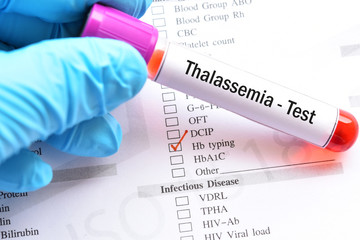 Blood sample for thalassemia test