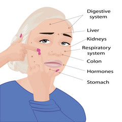 Face mapping. What your acne telling you info-graphic