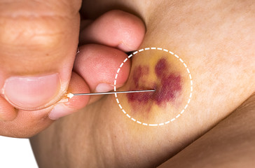 Hand doctor treats bruise (contusion) on the skin.White background.Closed up.Clipping path