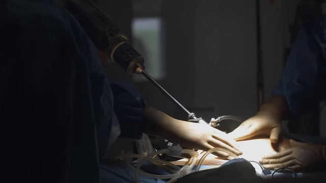 Operating room, team of surgeons prepares patient to cancer removal surgery via Robotic Surgery with Surgical System. Hi-tech medical robot