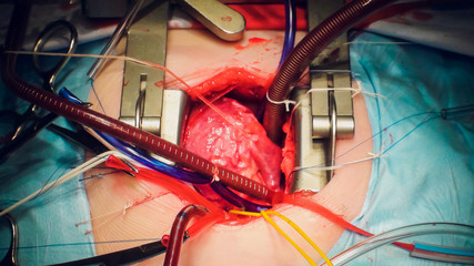 Doctor doing heart operation heart transplant operation