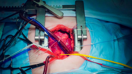 Doctor doing heart operation heart transplant operation