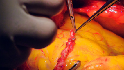 Doctor doing heart operation heart transplant operation