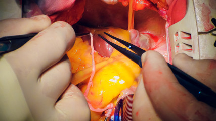 Doctor doing heart operation heart transplant operation