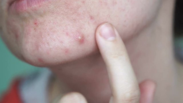 Closeup woman face with big ugly pimple. Acne teenager, skin problem person 4k