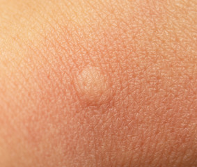 Fototapeta premium mosquito bite on the skin
