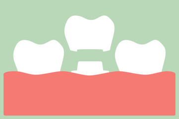 dental crown, installation process and change of teeth