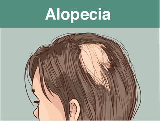  vector illustration of aFemale alopecia