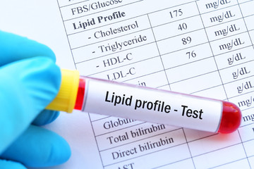 Blood sample with normal lipid profile result