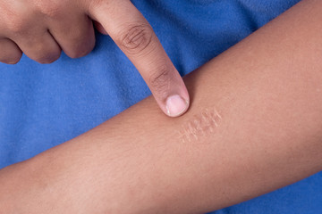 a scars at hand