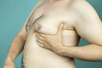 fat white middle-aged man with Gynecomastia, enlarged breast