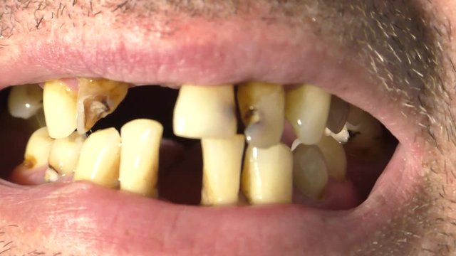 Bad teeth, mouth, unhealthy, horror. Missed teeth