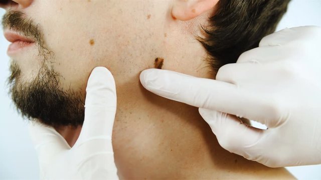 Doctor examine skin mole on person face close-up 4K