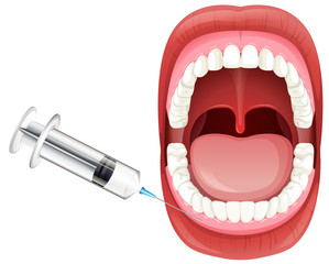 Mouth Anatomy showing Gum Injection