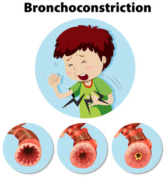 Human Anatomy Bronchoconstriction on White Background