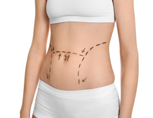 Fototapeta premium Young woman with marks on belly for cosmetic surgery operation against white background
