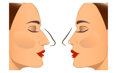 Rhinoplasty