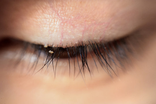 close up severe conjunctivitis from eyelash mites