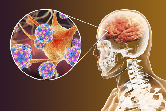 Encephalitis caused by enteroviruses, medical concept, 3D illustration showing brain infection and close-up view of neurons infected by viruses Coxsackie, Echo, Polio or other Picornaviruses