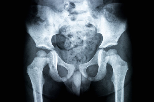 X-ray of pelvis and spinal column