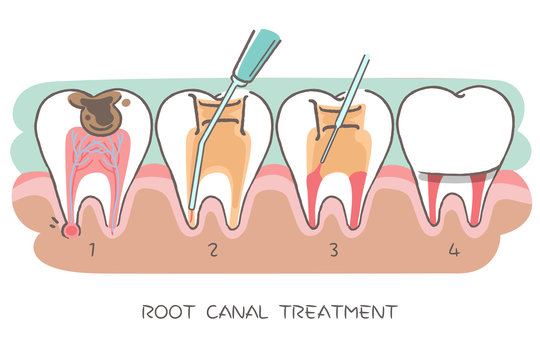 tooth with root canal treatment