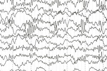 Abnormal EEG  brain wave