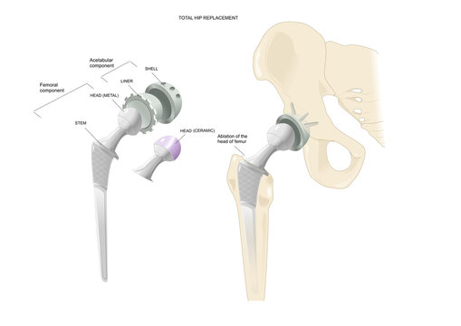 total hip replacement, with an artifical prosthesis