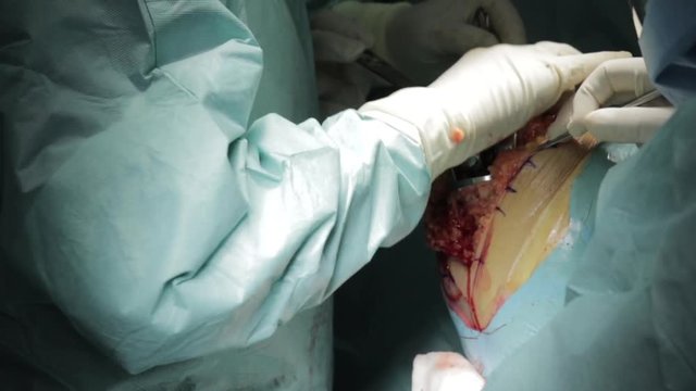 Close up, performing knee surgery