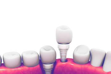 Dental implant structure - obrazy, fototapety, plakaty