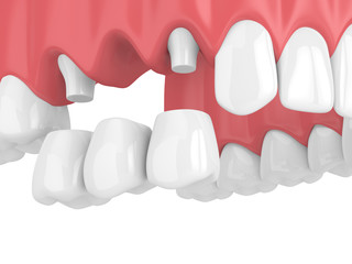 3d render of dental bridge with crowns in upper jaw