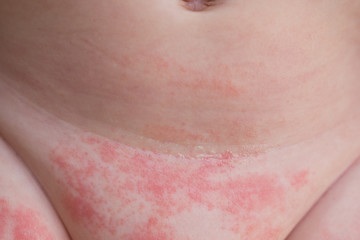 Yeast diaper rash and dermatitis on the belly of a newborn baby  - obrazy, fototapety, plakaty