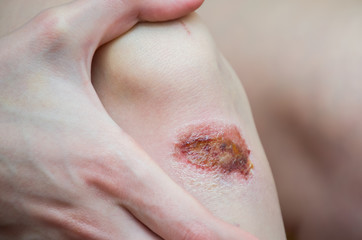 abrasion on the knee of a girl