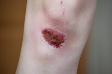 Fototapeta premium abrasion on the knee of a girl